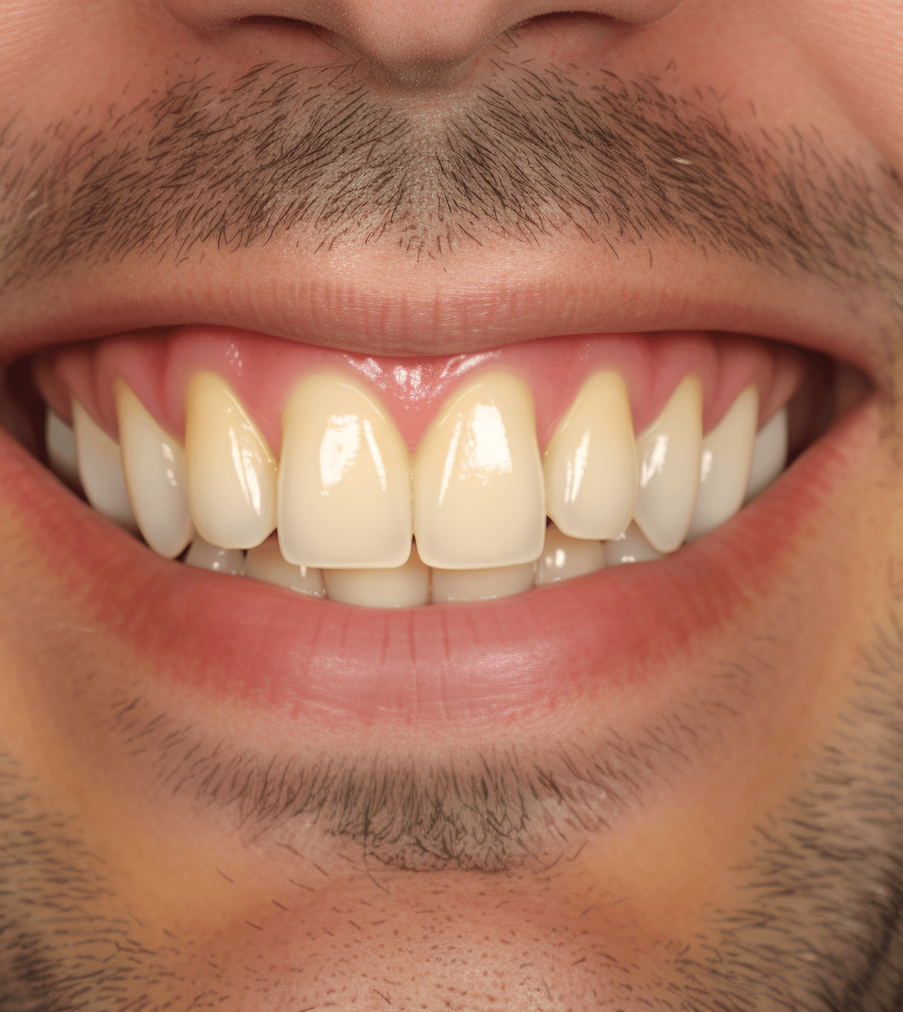 Before dental care at City South Dental