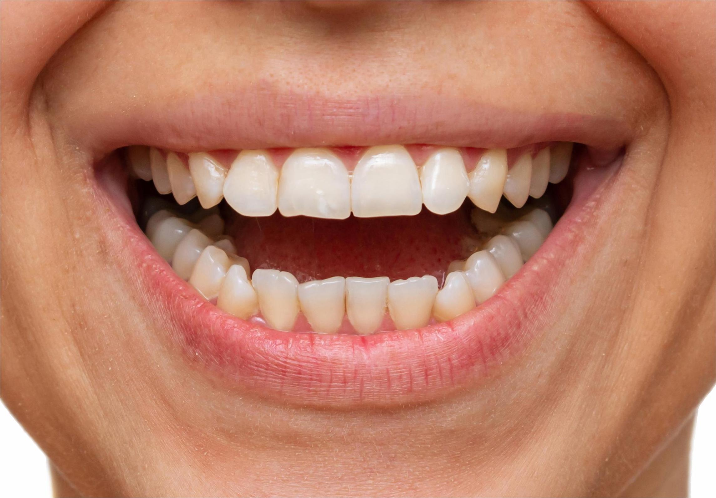 Before dental care at City South Dental